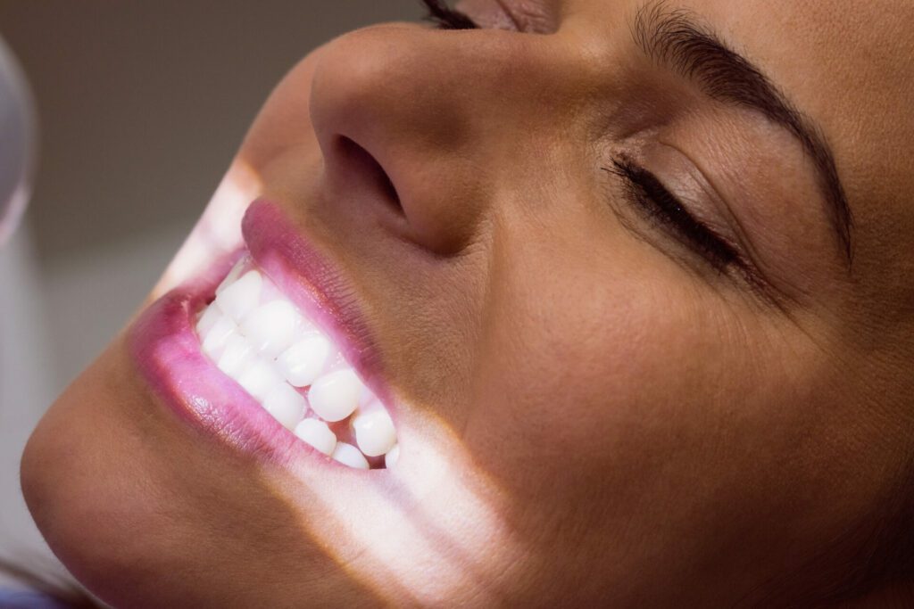 blanqueamiento dental en una mujer