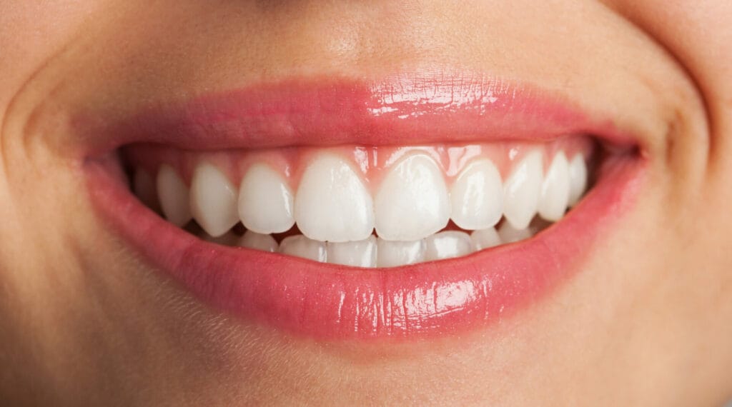 Sonrisa perfecta blanqueamiento dental en Palma